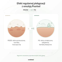Efekt regularnej pielęgnacji z emulsją Psorisel do skóry głowy