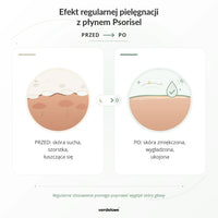 Efekt regularnej pielęgnacji z płynem Psorisel do skóry głowy