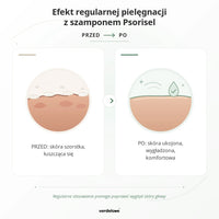 Efekt regularnej pielęgnacji z szamponem Psorisel do skóry głowy